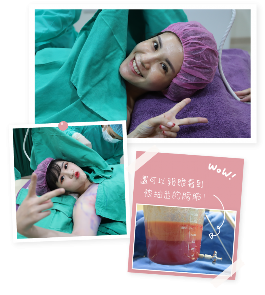 清醒手術大多數的個案可以在清醒的狀態下完成手術，甚至會在抽脂過程自然睡著，術後能夠自行返回，恢復過程相對舒適。