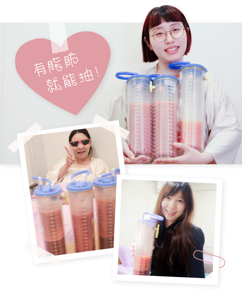 顯微套管抽脂FQA基本上只要有脂肪的地方都可以進行，無論是大面積或是局部抽脂