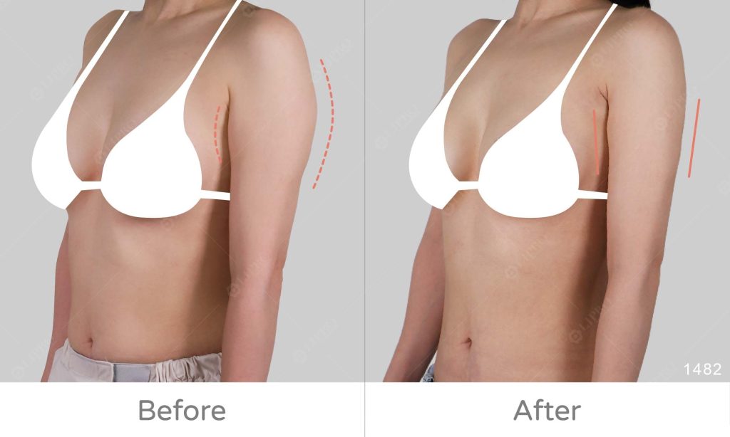 手臂案例成果展示、顯微套管抽脂可清醒手術