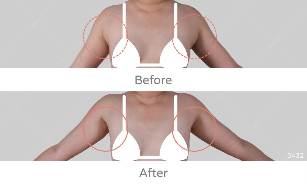 靠運動難以消除？副乳形成的原因是它！副乳抽脂案例分析