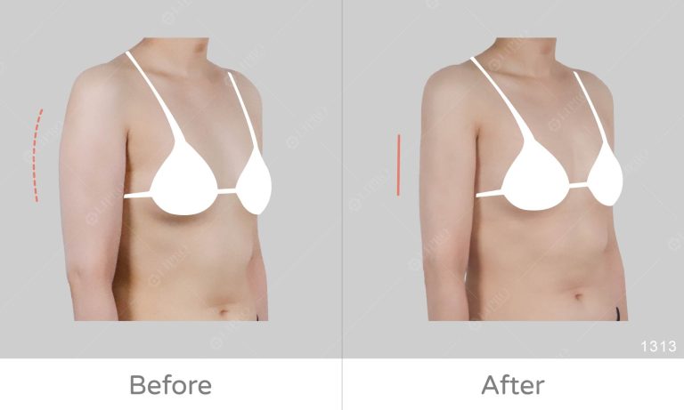 手臂曲線修飾、顯微套管抽脂精緻調整上半身曲線