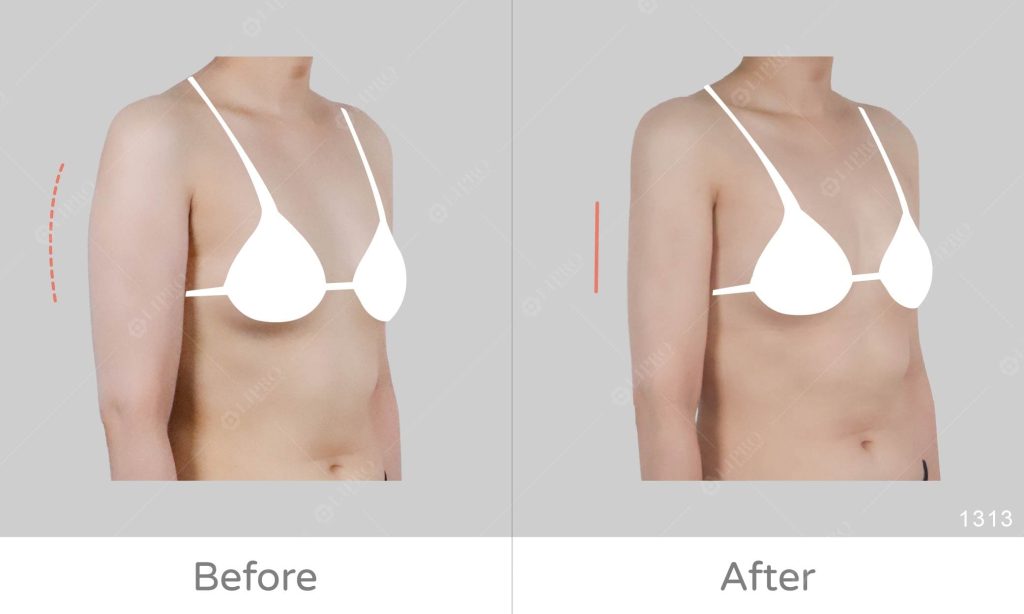 手臂曲線修飾、顯微套管抽脂精緻調整上半身曲線