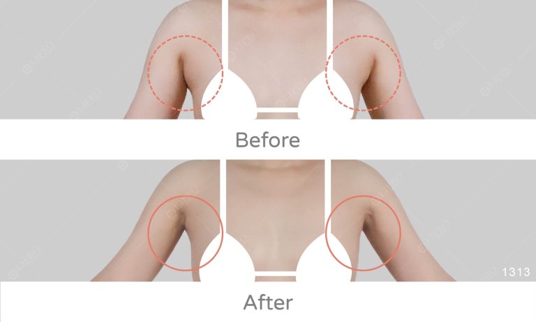 透過顯微套管抽脂移除乳腺，可以一併達到皮膚收縮的效果，打造渾然天成的精緻手臂。