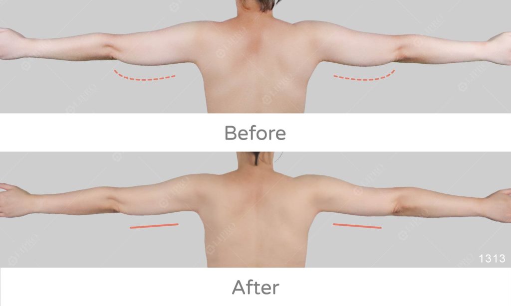 手臂蝴蝶袖曲線修飾，抽脂技術決定術後曲線平順