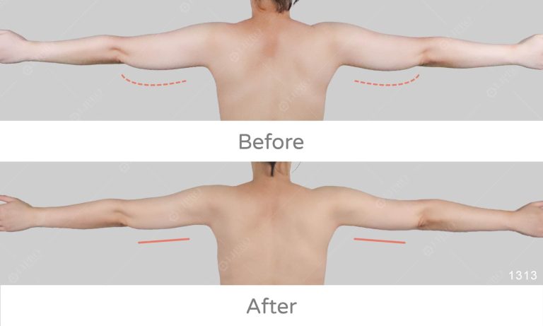手臂蝴蝶袖曲線修飾，抽脂技術決定術後曲線平順
