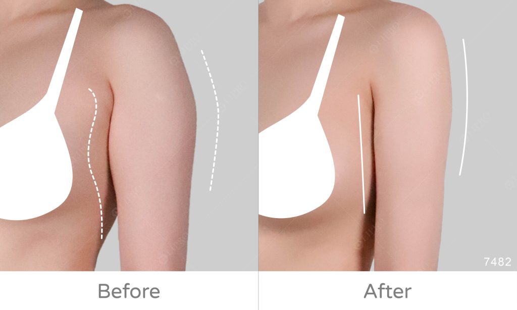 內側跟前側一樣重要，安全性要求必須更高，麗波永康注重手臂全方位細節修飾