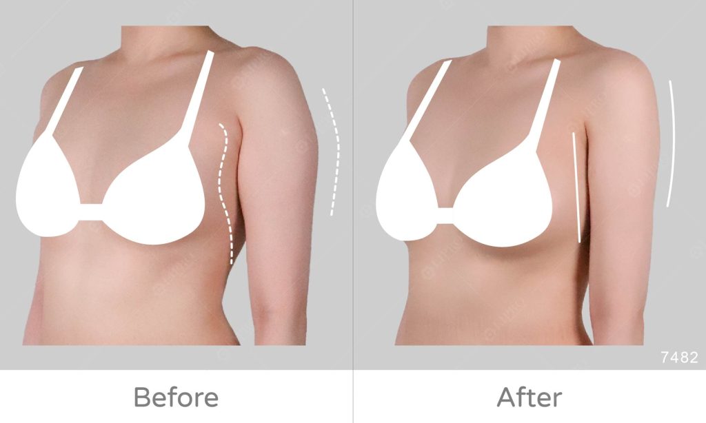 手臂內外側曲線兼顧，麗波會選擇做手臂360度整體雕塑的處理，才能夠不留下任何死角