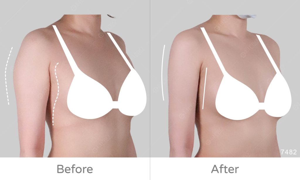 經過顯微套管抽脂細緻調整曲線的設計，可以看到術後精緻的曲線。