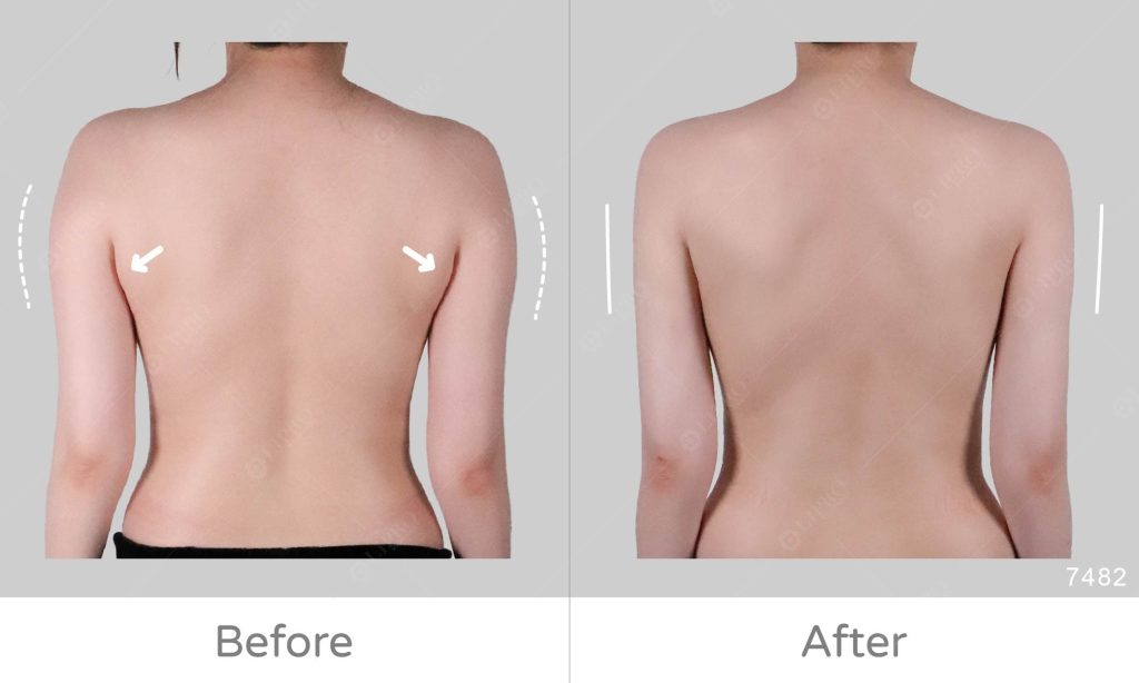 此個案後副乳與手臂曲線一併處理後，背影非常顯瘦！