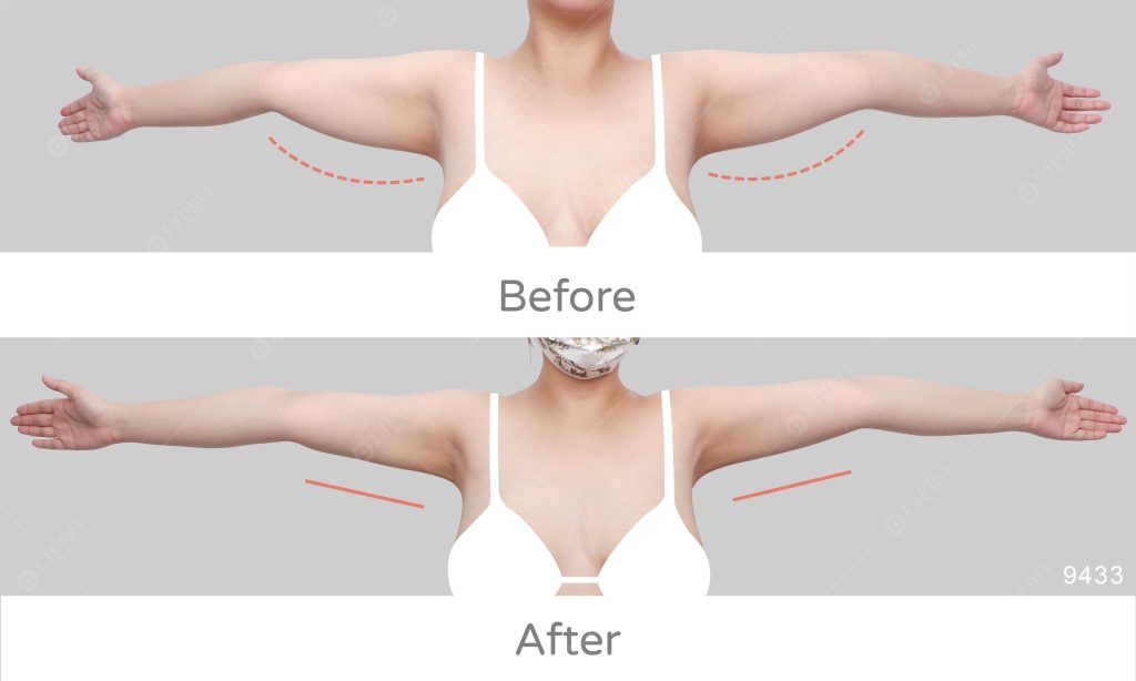 顯微套管技術在組織裡製造出讓皮膚緊縮的模型，運用空洞緊緻使皮膚組織自然回彈
