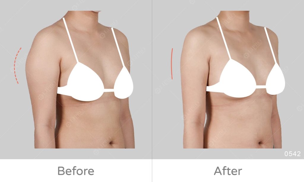 此為天生手臂脂肪囤積在三角肌上方及手臂內側較明顯的案例