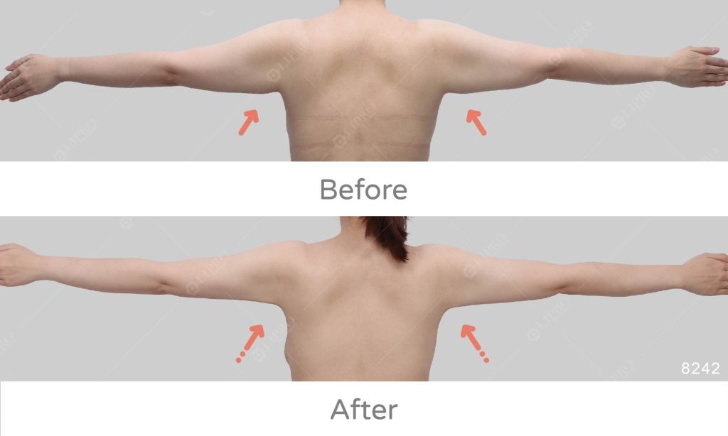 顯微套管抽脂管徑小、相對容易保留完好脂肪層筋膜與皮膚韌帶，維持皮膚彈性