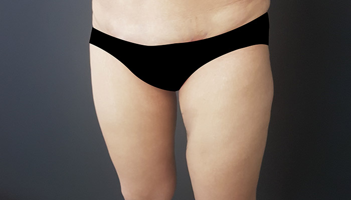 一般傳統體雕五大問題點〡分析參考：常見凹凸不平、大腿內側沒線條、臀部微笑線易下垂、需二次手術或補救...