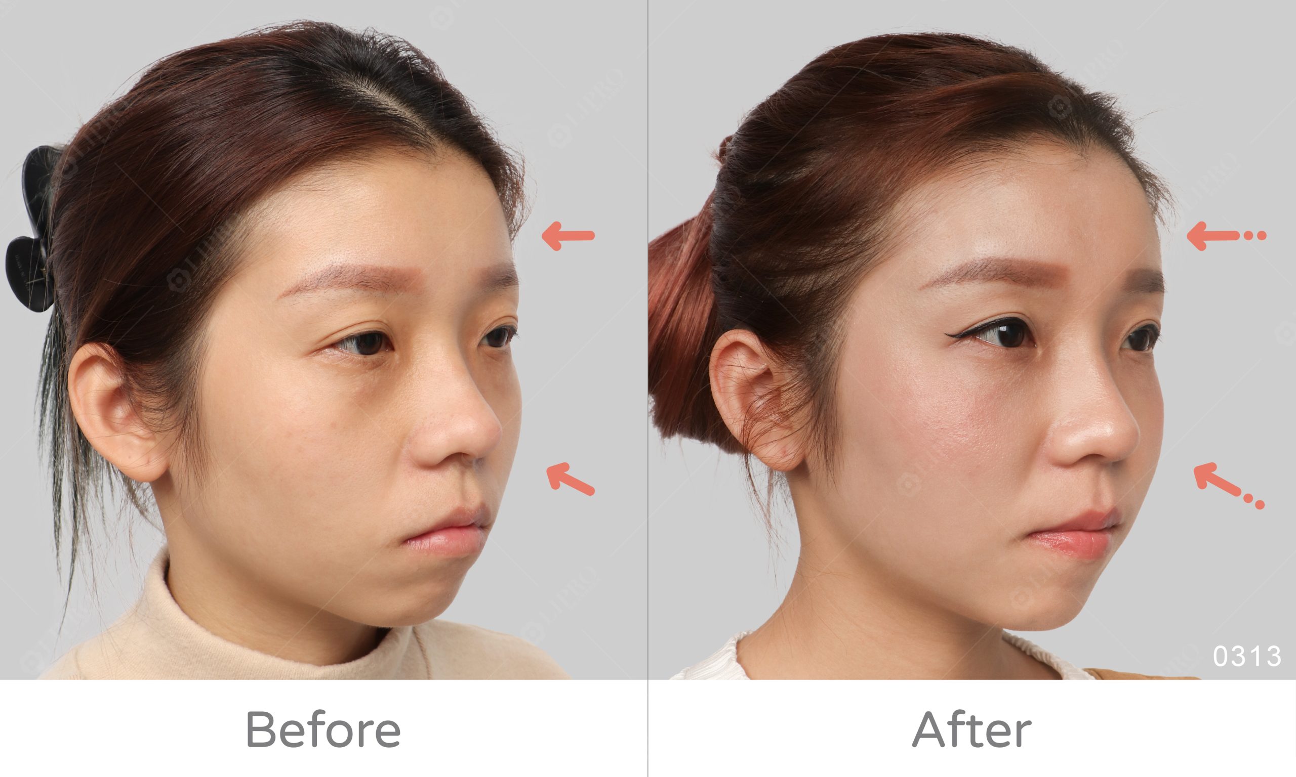 麗波永康精緻自體補臉BA案例展示