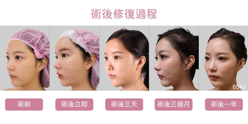 自體脂肪補臉恢復過程紀錄