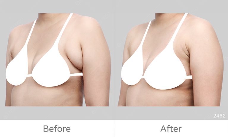 嚴重副乳怎麼辦?麗波永康專精顯微套管抽脂術，不用切皮就能消除嚴重副乳