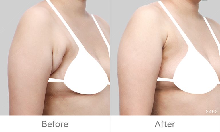 顯微套管抽脂術，不用切皮就能消除嚴重副乳、術後傷口小，恢復速度快