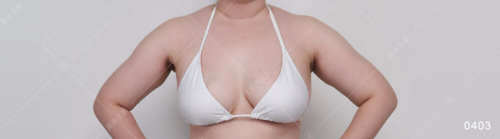 顯微套管抽脂消副乳，副乳抽脂恢復期第一個月的恢復狀況良好