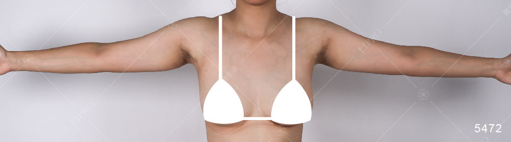 顯微套管抽脂消副乳，腋下贅肉消除改善上半身曲線