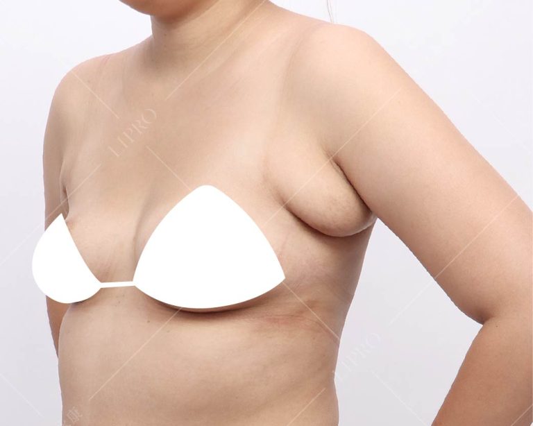 嚴重副乳術前困擾2462左側腋下照片