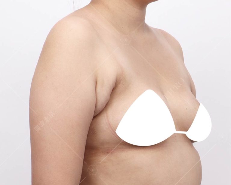 嚴重副乳術前困擾2462右側腋下照片