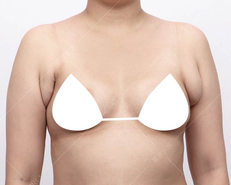 嚴重副乳術前困擾2462照片