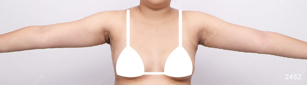 顯微套管抽脂手術，副乳抽脂術後恢復期，第一個月的恢復狀況如圖