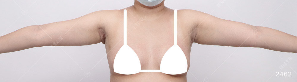 顯微套管抽脂、副乳抽脂術後恢復期，5個月後手術成效對比