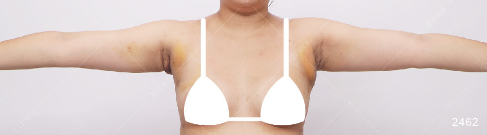 顯微套管副乳抽脂手術案例的恢復狀況紀錄，術後第6天仍有些許腫脹