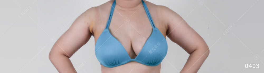 顯微套管抽脂手術消除腋下副乳，術後一周抽脂恢復期有腫脹與瘀青屬於正常恢復過程