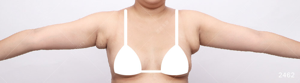 麗波永康顯微套管副乳抽脂手術，案例的術前個案狀況紀錄