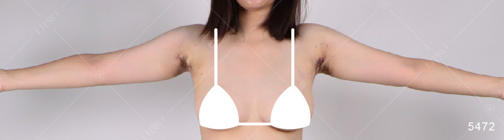 顯微套管抽脂恢復期多久?副乳抽脂手術後第九天的腫漲和瘀青還沒有消退