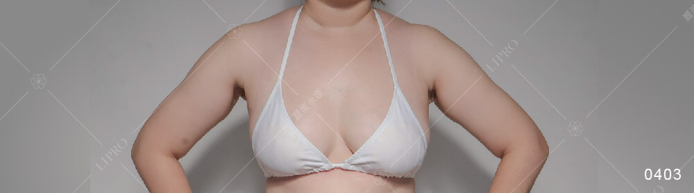 麗波永康副乳抽脂案例分享，個案於副乳手術後6個月的恢復與成效