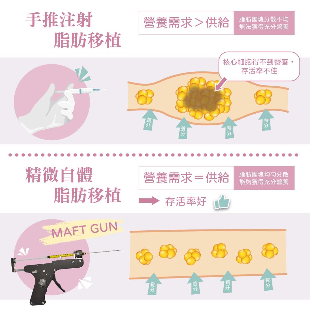 精微自體脂肪移植對比傳統手法，存活率提升