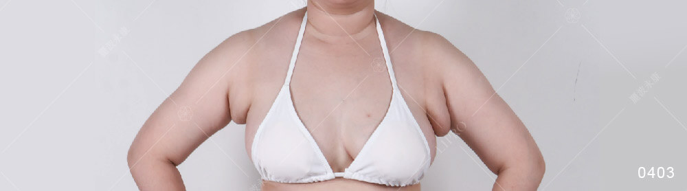 巨大副乳、腋下副乳消不掉怎麼辦?副乳案例術前紀錄照片
