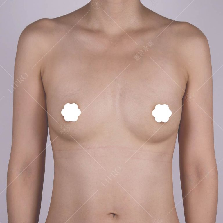 自體脂肪豐胸術後照護非常簡單，幾乎沒有什麼恢復期