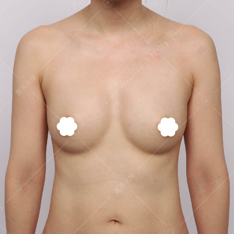 胸部皮膚上會有一些黃黃綠綠的麻藥顏色，大約兩周就會消退。