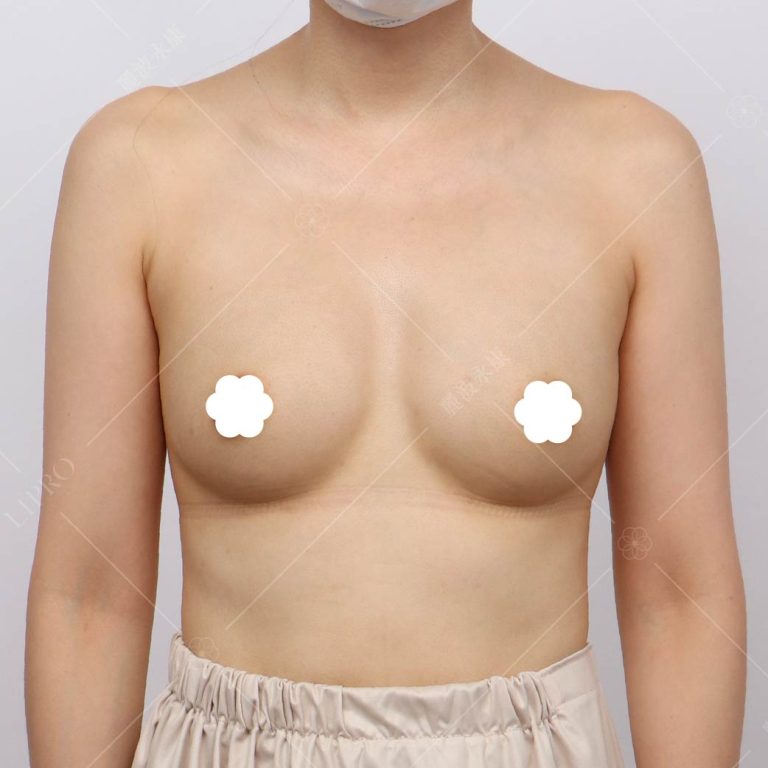 術後只需要記得穿著寬鬆的內衣，且跟術前一樣維持均衡的營養、充足的睡眠