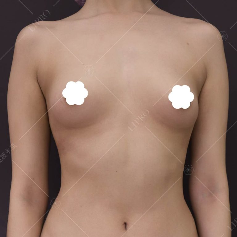 麗波永康本身執行過的案例來說，手術後續長期追蹤1～3年，仍保有不錯的效果