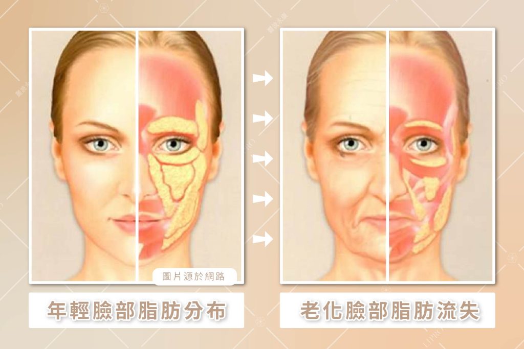 臉部脂肪老化流失