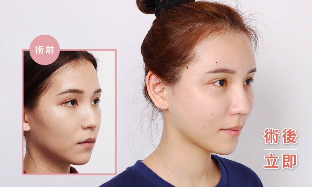 自體脂肪補臉術後立即傷口極小