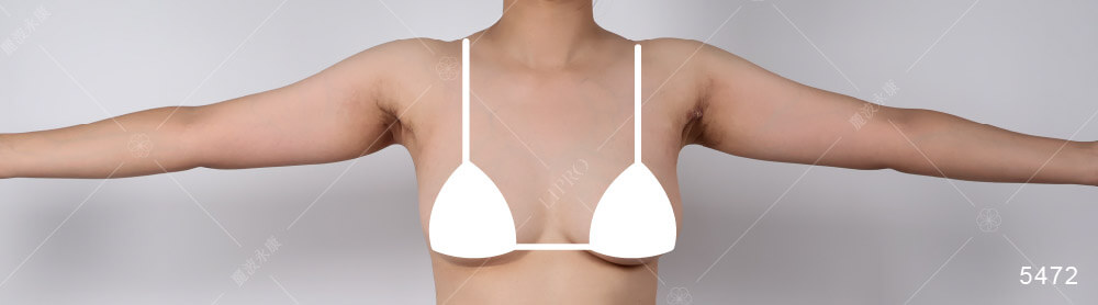 副乳手術dcard討論、副乳抽脂恢復期多久?分享副乳抽脂案例1個月的恢復情況