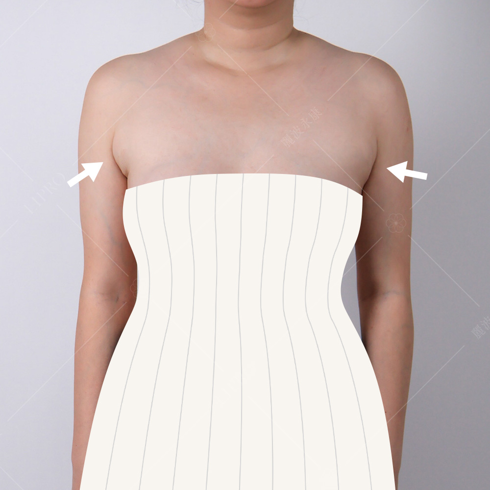 副乳術前困擾_無法駕馭平口禮服，圖為服裝模擬示意