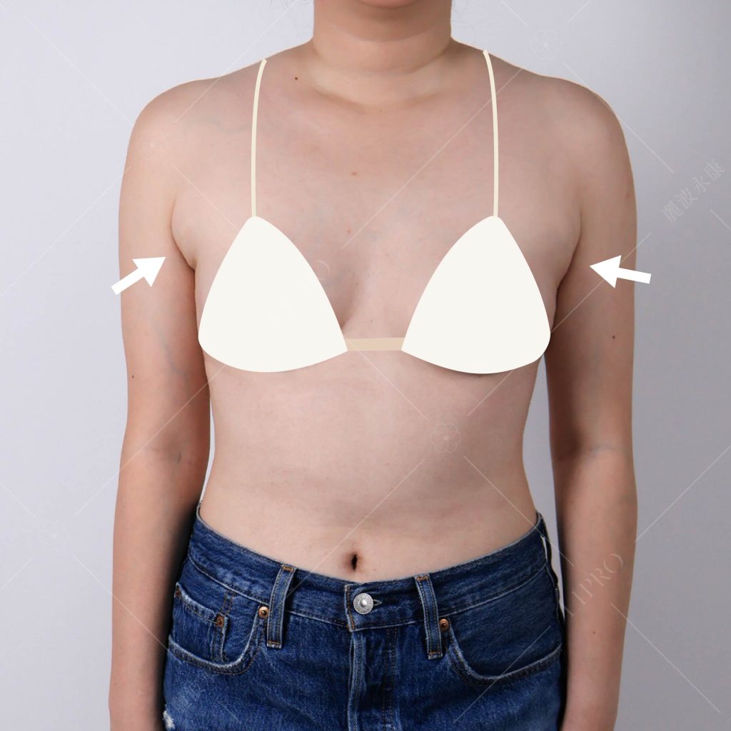 副乳術前困擾_無法駕馭泳裝比基尼，圖為服裝模擬示意