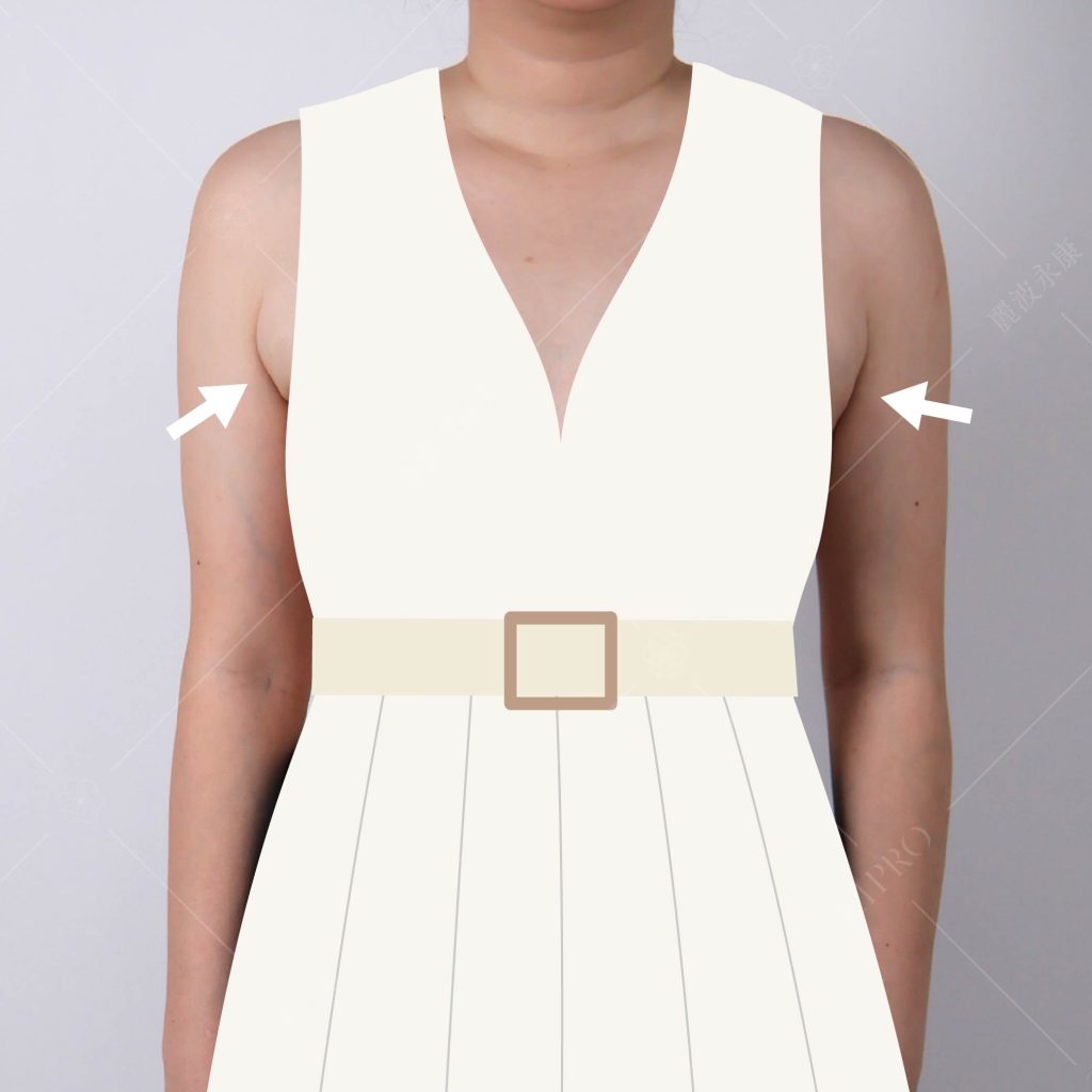 副乳術前困擾_無法駕馭無袖款式，圖為服裝模擬示意