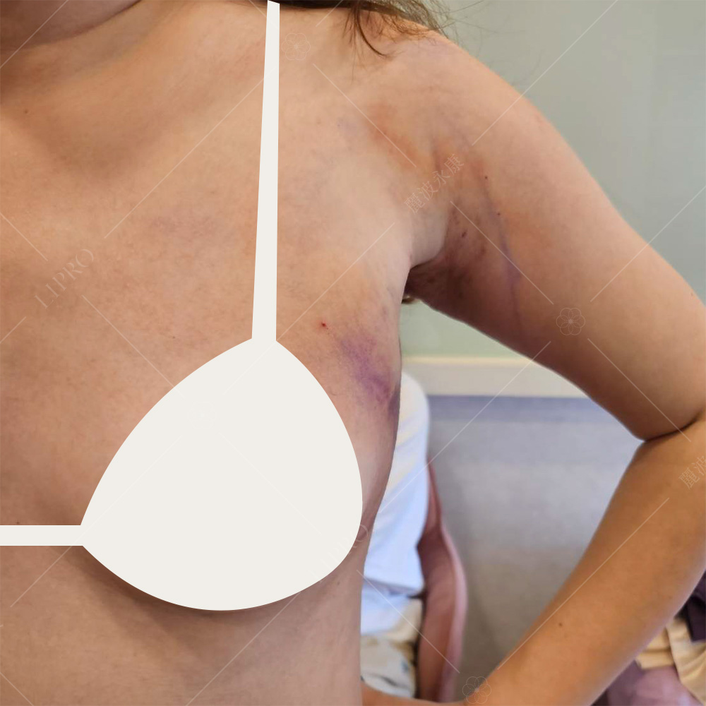 副乳抽脂案例術後第二天的真實狀況、瘀青為正常術後過程