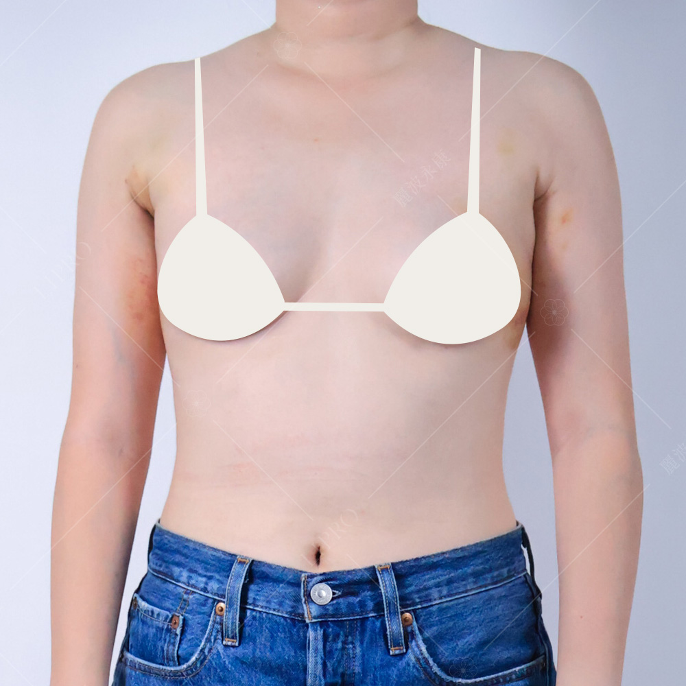 副乳抽脂術後第14天，瘀青消失，護理師時刻關心恢復狀況