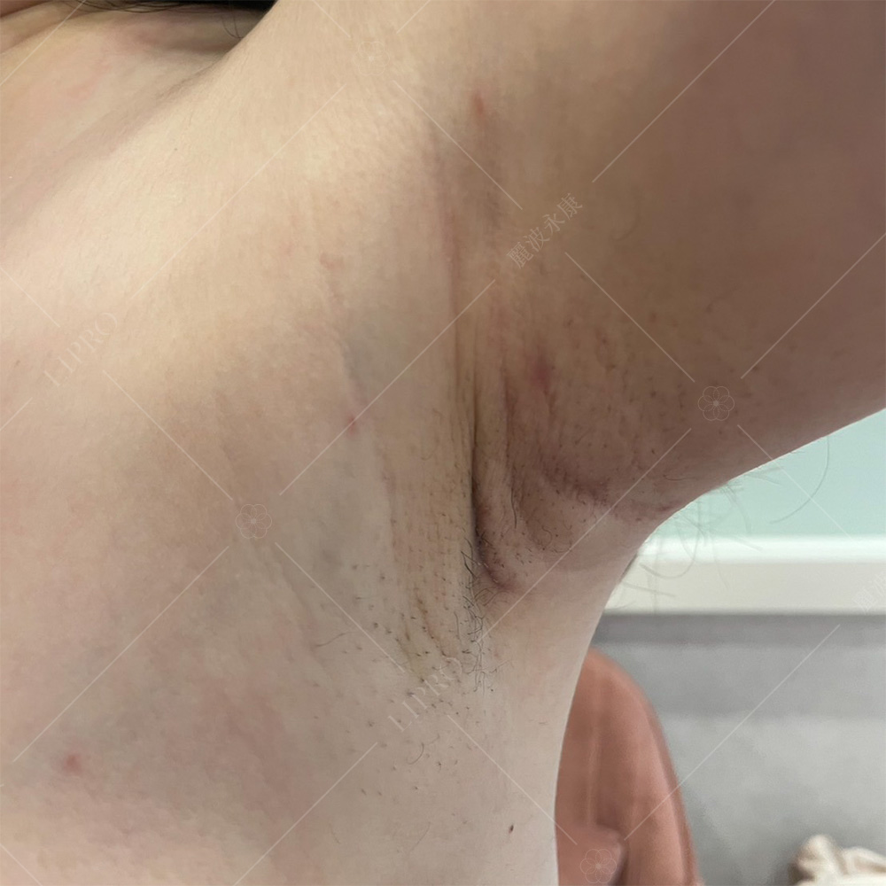 副乳抽脂術後第14天，左側腋下傷口恢復良好，幾乎看不出來