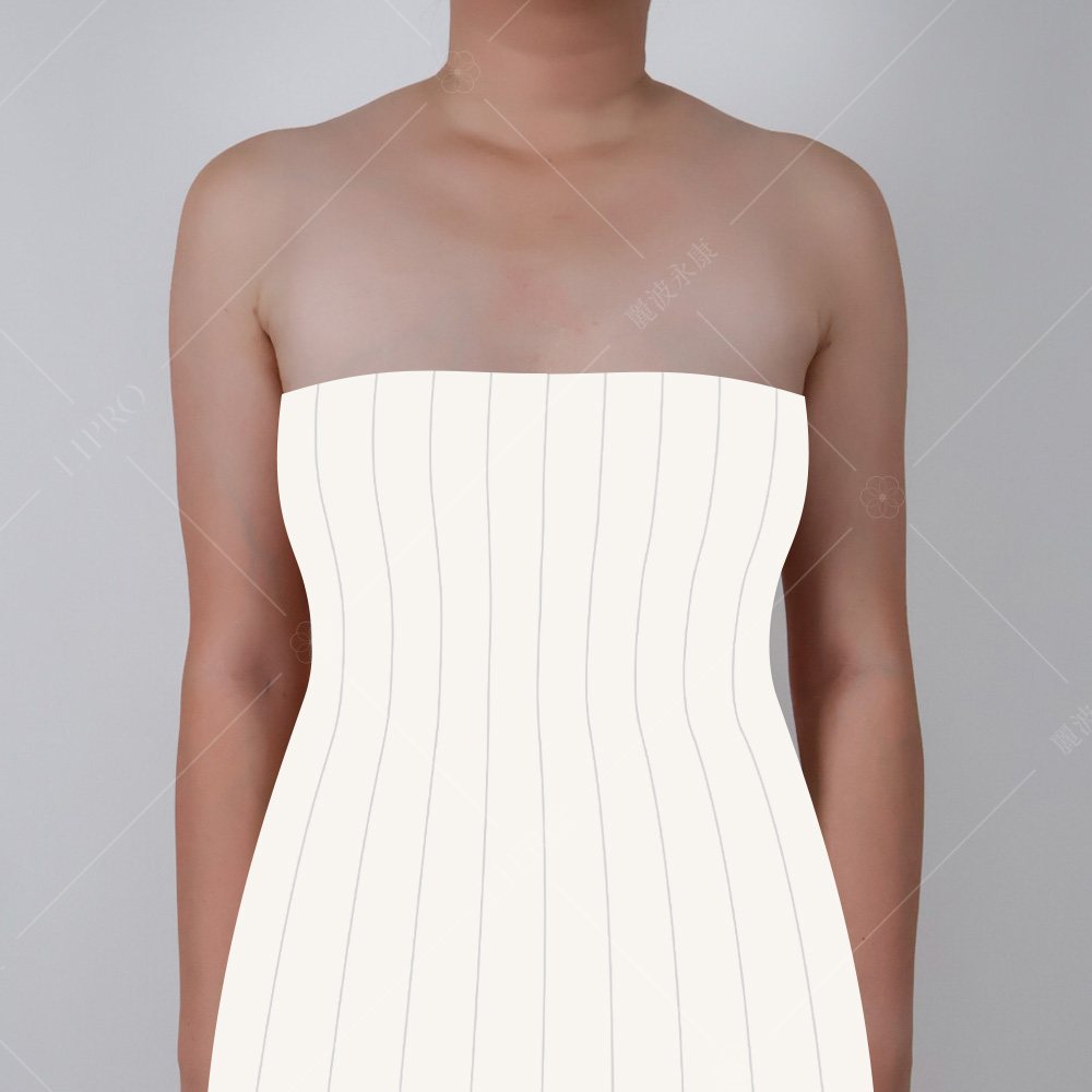感受一下副乳消除前後的身形差異，穿小禮服給人不一樣的感覺，圖為術後模擬圖