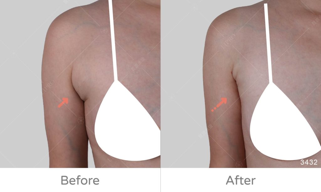 顯微套管抽脂案例、副乳抽脂手術案例成果展示